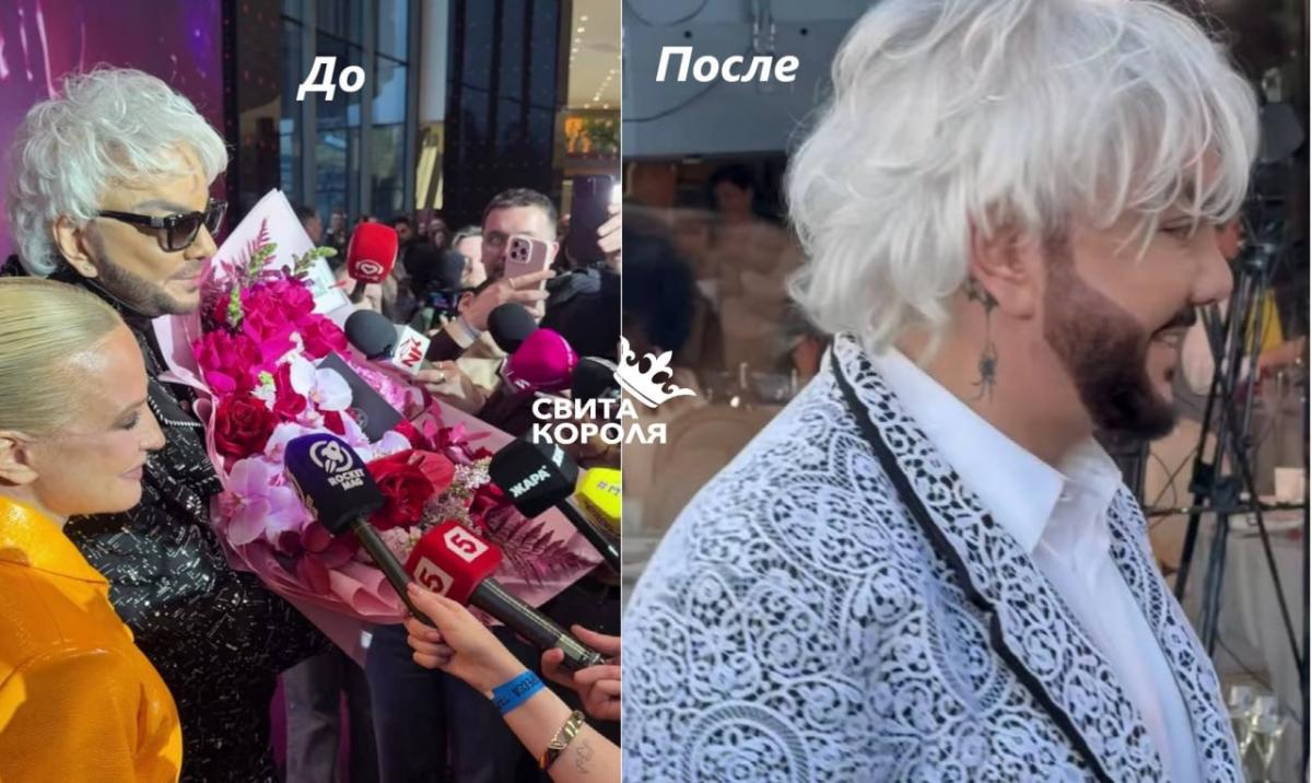Ніс Філіпа Кіркорова — до та після