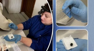 На Львівщині з вуха пацієнта медики дістали незвичний предмет На Львівщині з вуха пацієнта медики дістали незвичний предмет