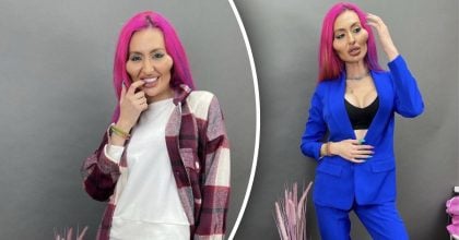 "Видалю все": українка з наймасивнішими вилицями вирішила видалити філери