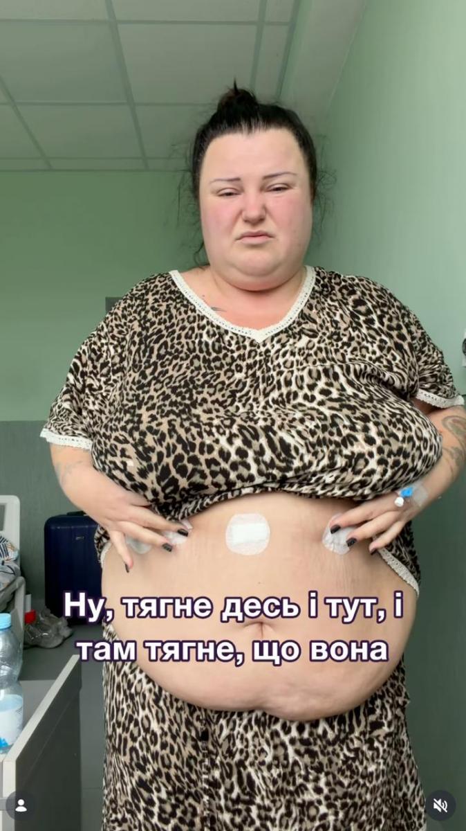 Alyona Alyona - баріатрична операція