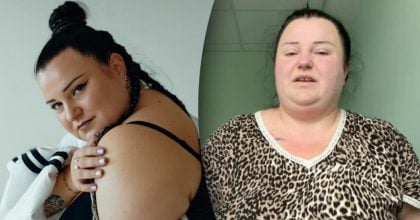 "Мені боляче": Alyona Alyona показала живіт після зменшення шлунка